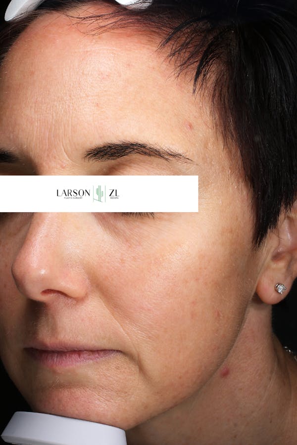 Laser Before & After Gallery - Patient 140819535 - Image 2
