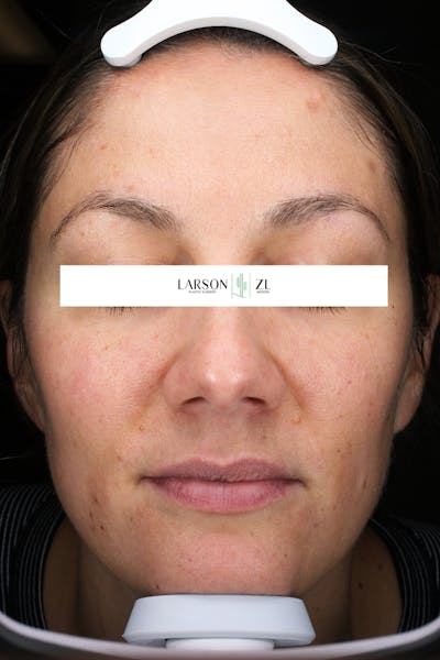Laser Before & After Gallery - Patient 140819534 - Image 1