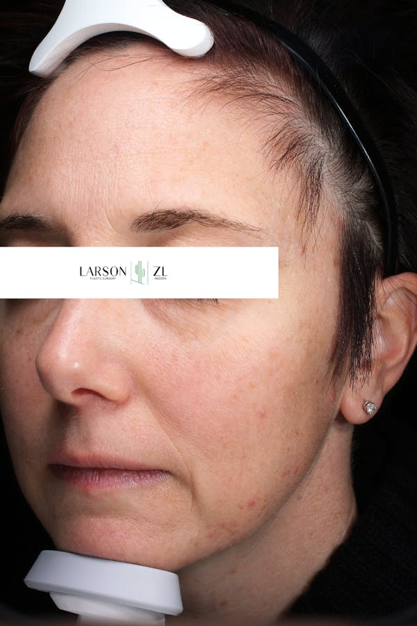 Laser Before & After Gallery - Patient 140819535 - Image 1