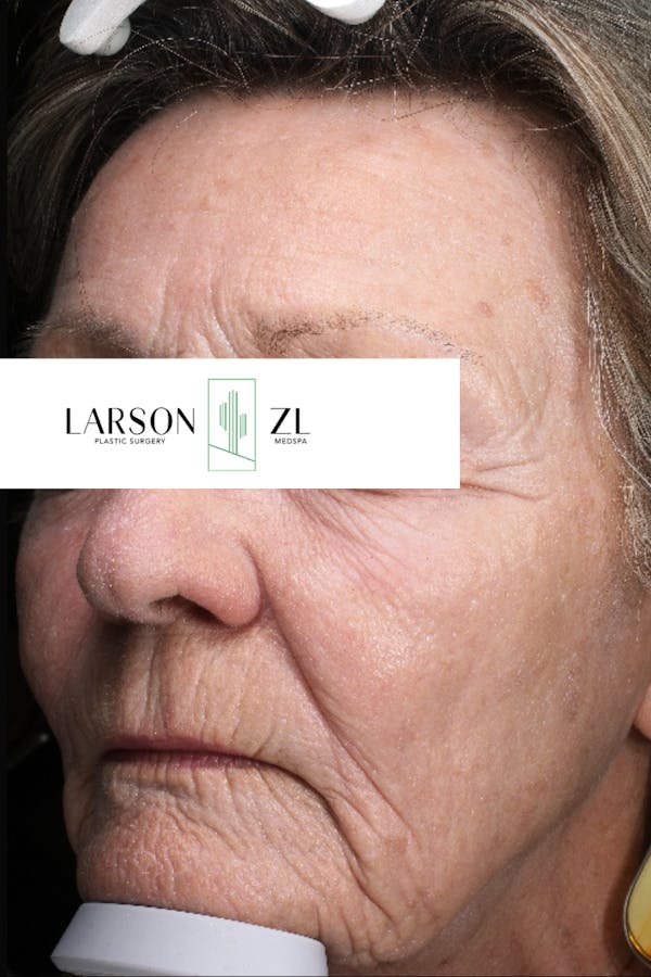 Laser Before & After Gallery - Patient 140819536 - Image 2