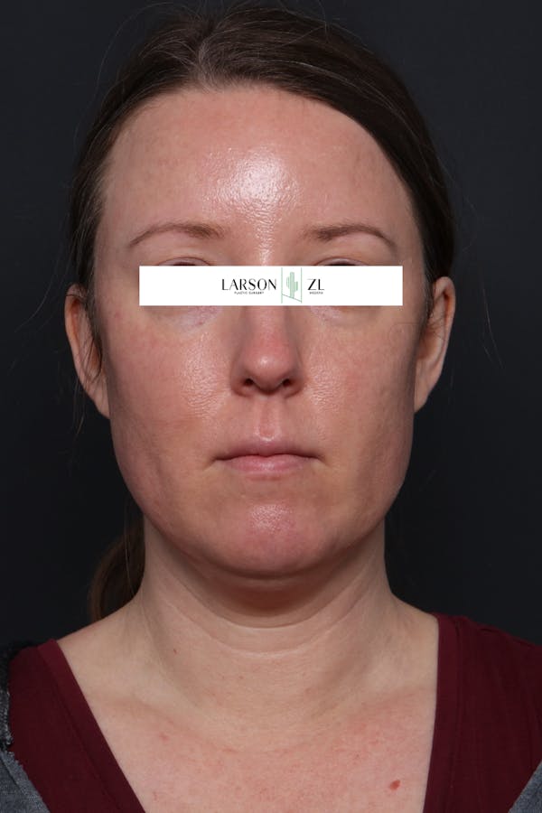 Laser Before & After Gallery - Patient 140819537 - Image 2