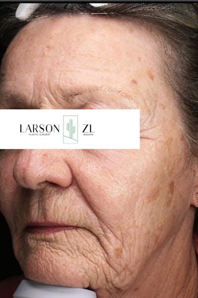 Laser Before & After Gallery - Patient 140819536 - Image 1