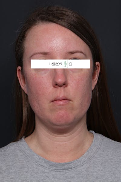 Laser Before & After Gallery - Patient 140819537 - Image 1