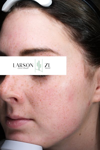 Acne & Acne Scarring Before & After Gallery - Patient 140819571 - Image 2