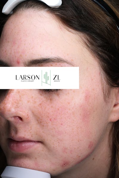 Acne & Acne Scarring Gallery - Patient 140819571 - Image 1