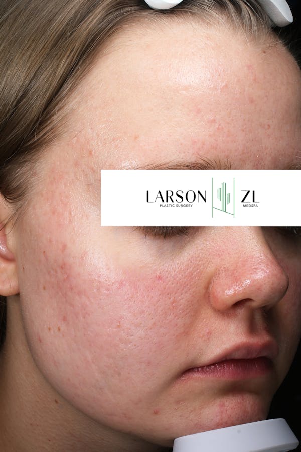 Acne & Acne Scarring Before & After Gallery - Patient 140819572 - Image 1