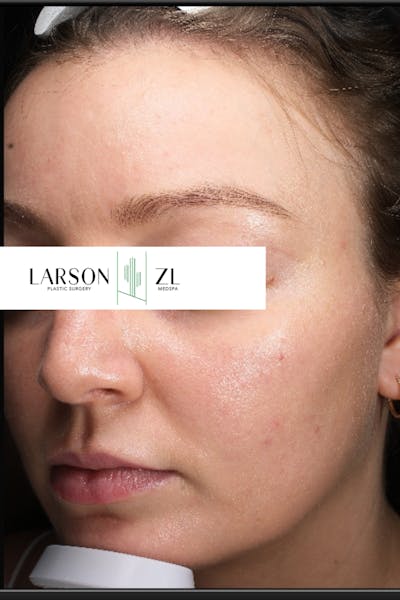 Acne & Acne Scarring Before & After Gallery - Patient 140819573 - Image 2