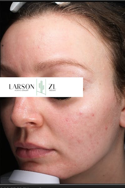 Acne & Acne Scarring Before & After Gallery - Patient 140819573 - Image 1