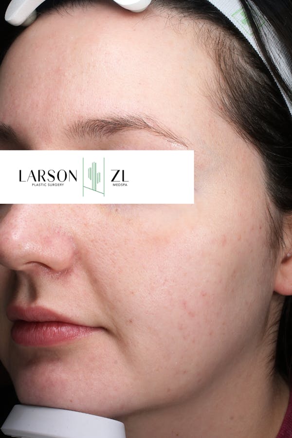 Acne & Acne Scarring Before & After Gallery - Patient 140819575 - Image 2