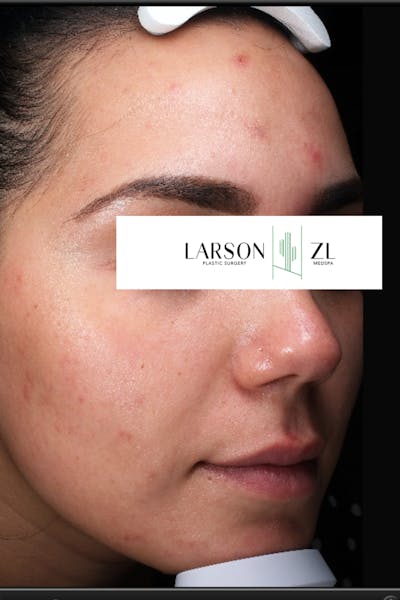 Acne & Acne Scarring Before & After Gallery - Patient 140819574 - Image 1