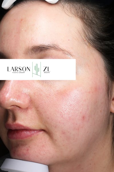 Acne & Acne Scarring Before & After Gallery - Patient 140819575 - Image 1