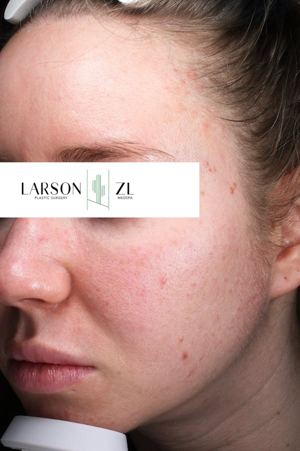 Acne & Acne Scarring Before & After Gallery - Patient 140819576 - Image 1