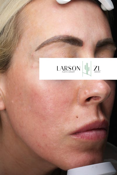Hyperpigmentation Before & After Gallery - Patient 140819584 - Image 2