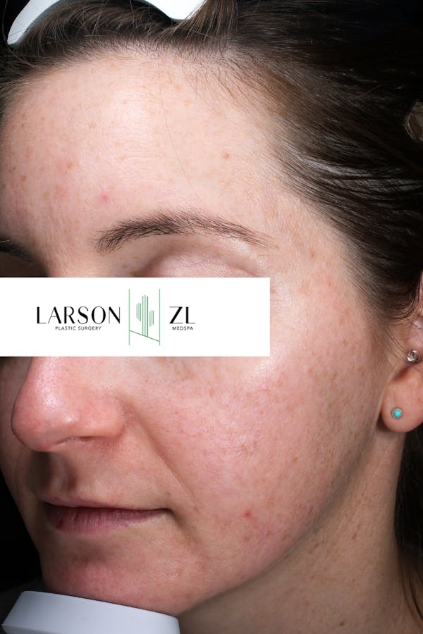 Hyperpigmentation Before & After Gallery - Patient 140819585 - Image 2