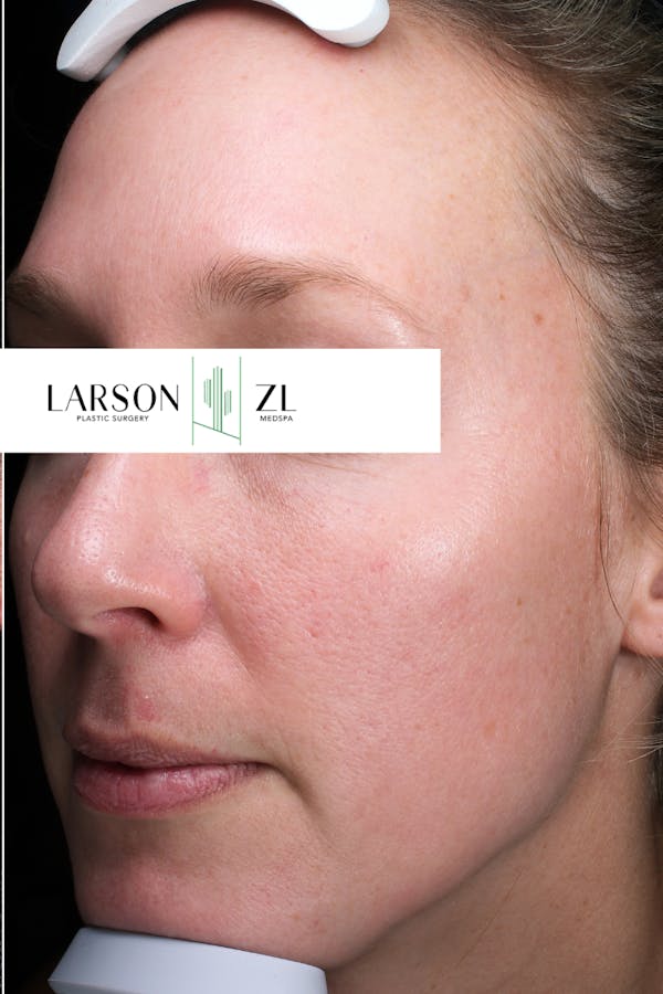 Hyperpigmentation Before & After Gallery - Patient 140819586 - Image 2