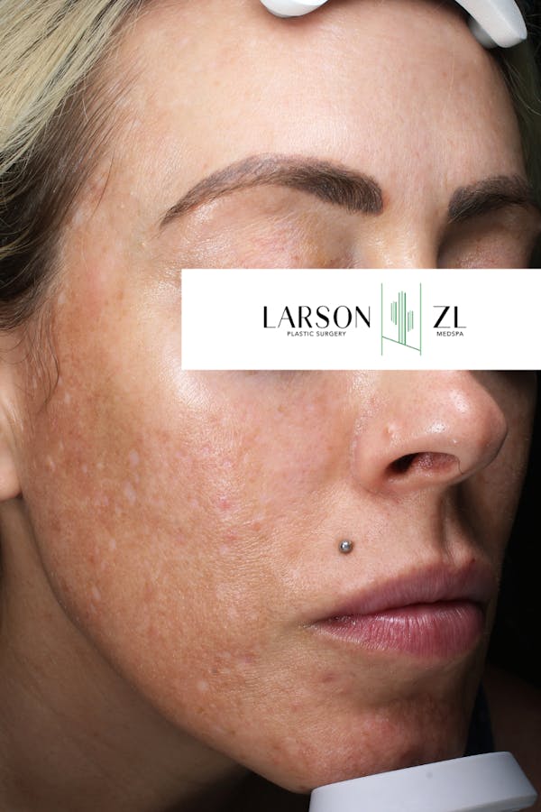 Hyperpigmentation Before & After Gallery - Patient 140819584 - Image 1