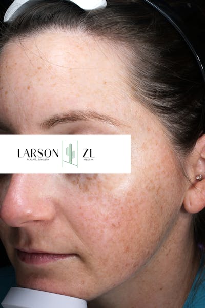 Hyperpigmentation Before & After Gallery - Patient 140819585 - Image 1