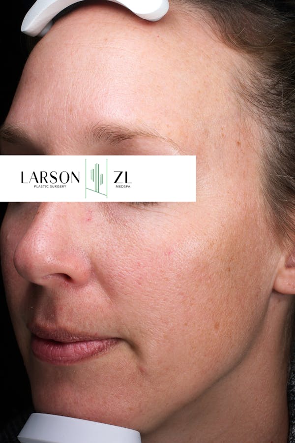Hyperpigmentation Before & After Gallery - Patient 140819586 - Image 1