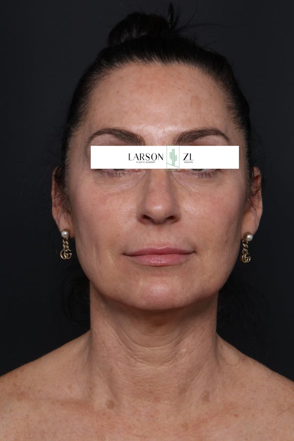 Sculptra Before & After Gallery - Patient 140819595 - Image 2