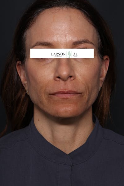 Sculptra Before & After Gallery - Patient 140819596 - Image 2