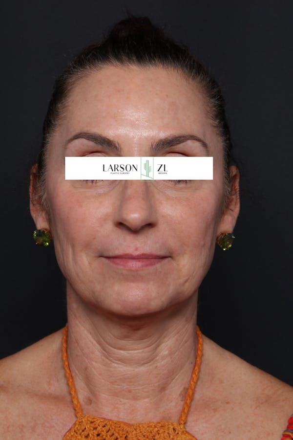 Sculptra Before & After Gallery - Patient 140819595 - Image 1