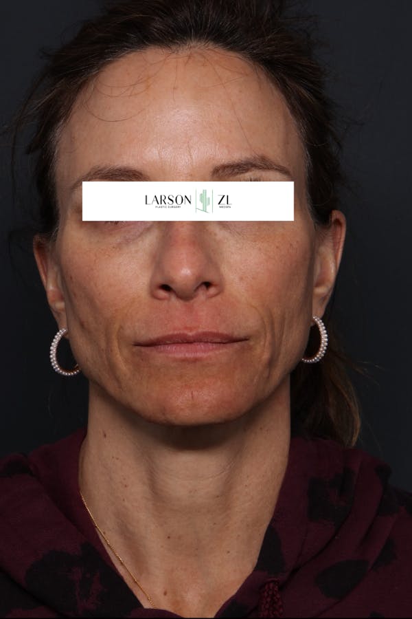 Sculptra Before & After Gallery - Patient 140819596 - Image 1