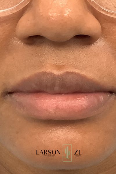 Filler Injections for Face Before & After Gallery - Patient 140819643 - Image 2