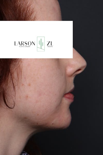 Filler Injections for Face Before & After Gallery - Patient 140819644 - Image 2