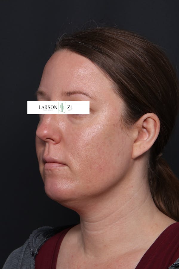 Filler Injections for Face Before & After Gallery - Patient 140819645 - Image 2