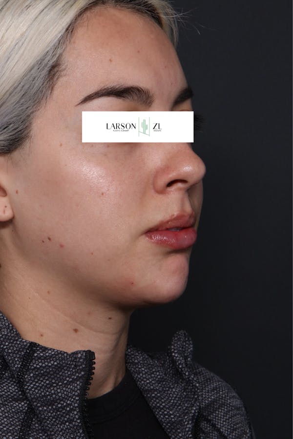 Filler Injections for Face Before & After Gallery - Patient 140819646 - Image 2