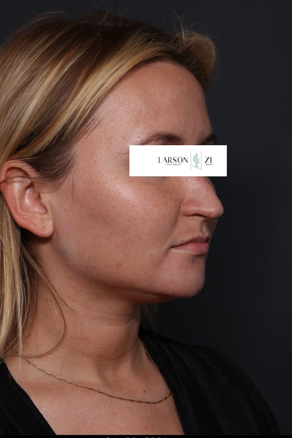 Filler Injections for Face Before & After Gallery - Patient 140819647 - Image 2