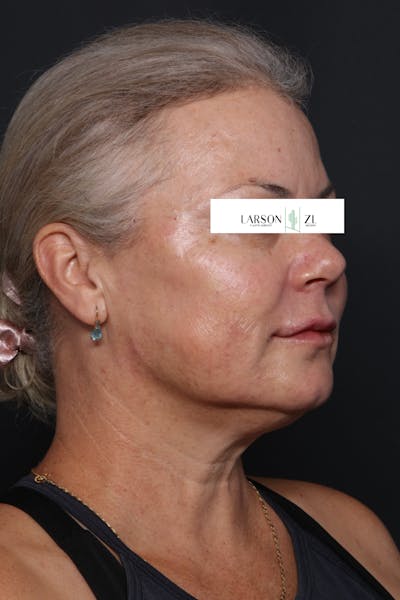Filler Injections for Face Before & After Gallery - Patient 140819648 - Image 2
