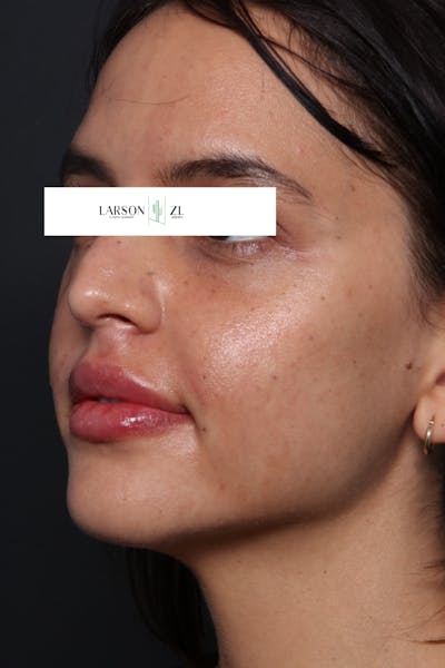 Filler Injections for Face Before & After Gallery - Patient 140819649 - Image 2