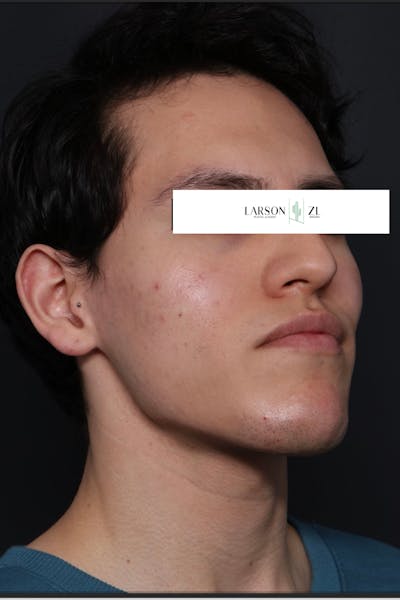 Filler Injections for Face Before & After Gallery - Patient 140819650 - Image 2