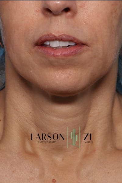 Filler Injections for Face Before & After Gallery - Patient 140819651 - Image 2