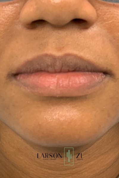 Filler Injections for Face Before & After Gallery - Patient 140819643 - Image 1