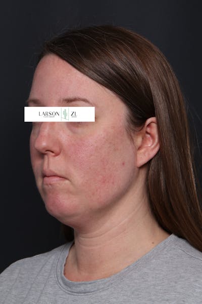 Filler Injections for Face Before & After Gallery - Patient 140819645 - Image 1