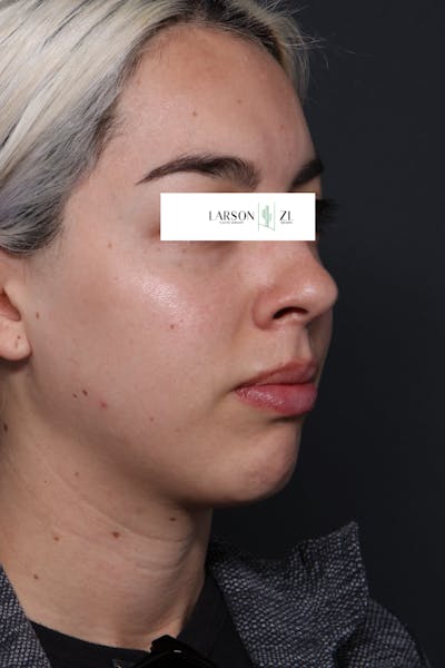 Filler Injections for Face Gallery - Patient 140819646 - Image 1