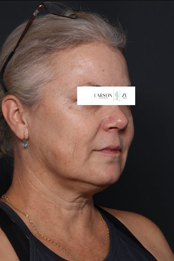 Filler Injections for Face Before & After Gallery - Patient 140819648 - Image 1