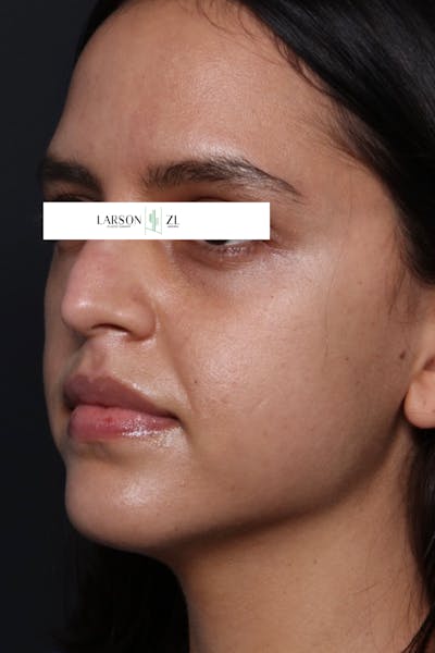 Filler Injections for Face Before & After Gallery - Patient 140819649 - Image 1