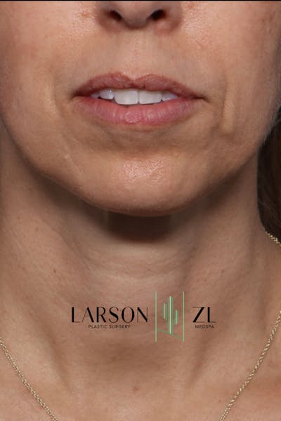 Filler Injections for Face Gallery - Patient 140819651 - Image 1