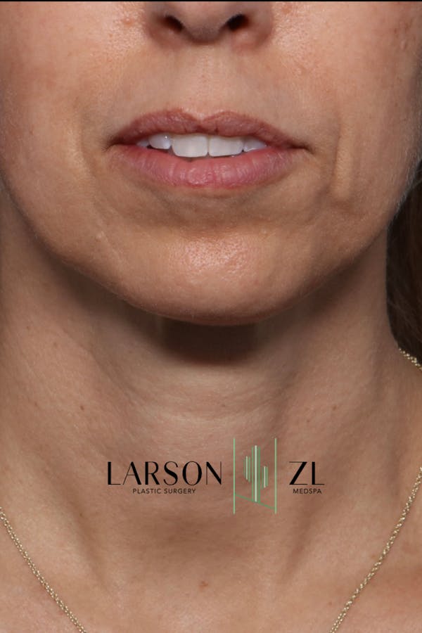 Filler Injections for Face Gallery - Patient 140819651 - Image 1