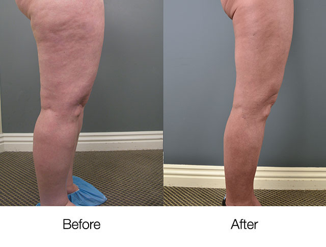 Lipedema Treatment Beverly Hills | Lipedema Surgery in Los Angeles