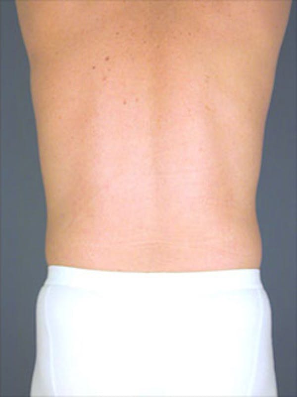 Patient 13934579 | Flanks Before & After Photos | David Amron, MD