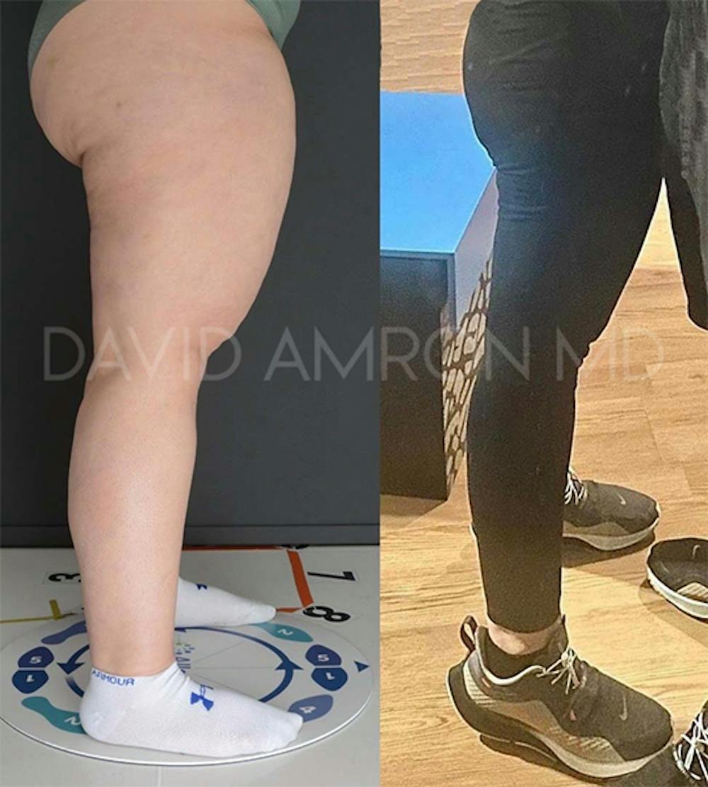 Albums 91+ Images Pictures Of Lipedema In Legs Superb