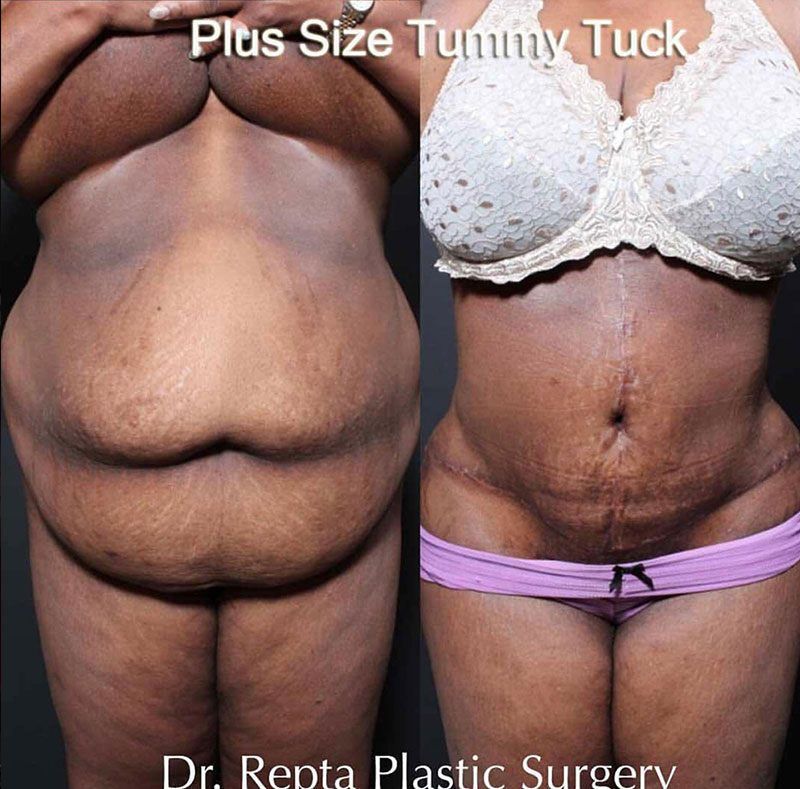 Before and after tummy tuck