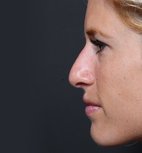 Rhinoplasty Before & After Gallery - Patient 14089515 - Image 5
