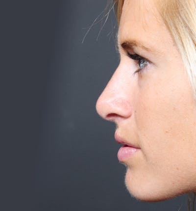 Rhinoplasty Before & After Gallery - Patient 14089515 - Image 6