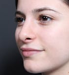 Rhinoplasty Before & After Gallery - Patient 14089516 - Image 2