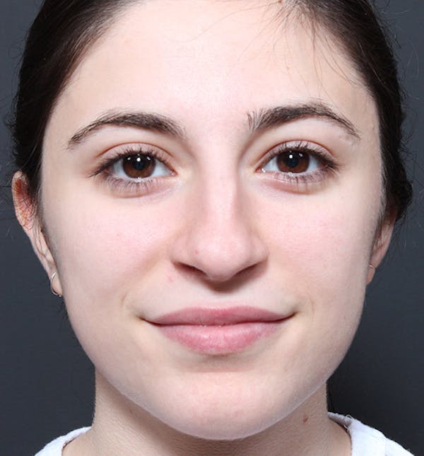 Rhinoplasty Before & After Gallery - Patient 14089516 - Image 3
